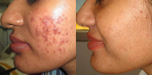 Acne Daag-Dhabbe Ka Ilaj: 13 Effective Skin Care Tips & Best Cream